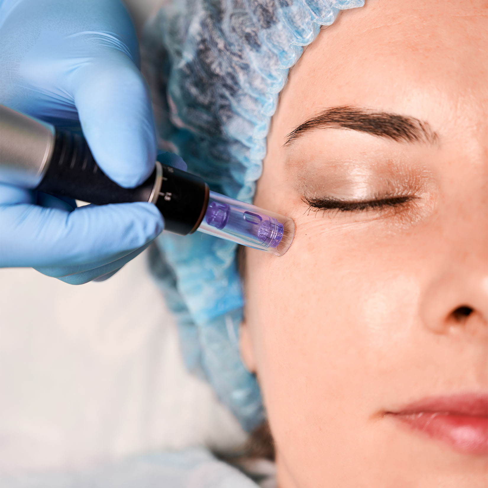 Tratamiento antiarrugas Dermapen – 3 sesiones